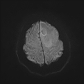 File:Neurotoxoplasmosis - concentric target sign (Radiopaedia 70644-80784 Axial DWI 19).jpg