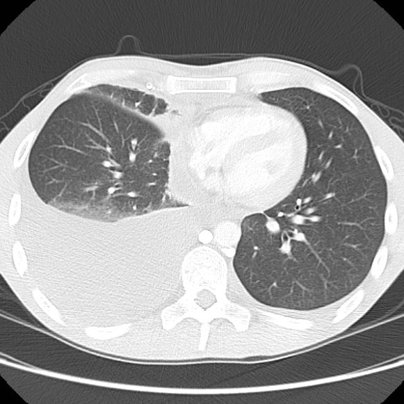 File:Non-Hodgkin lymphoma involving lung (Radiopaedia 29094-29470 Axial lung window 44).jpg