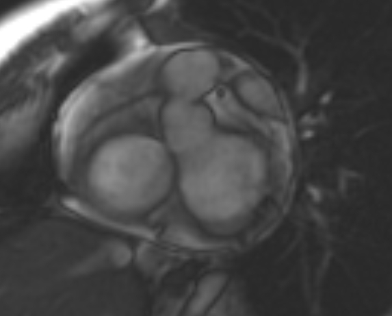 File:Non-compaction of the left ventricle (Radiopaedia 69436-79314 Short axis cine 218).jpg