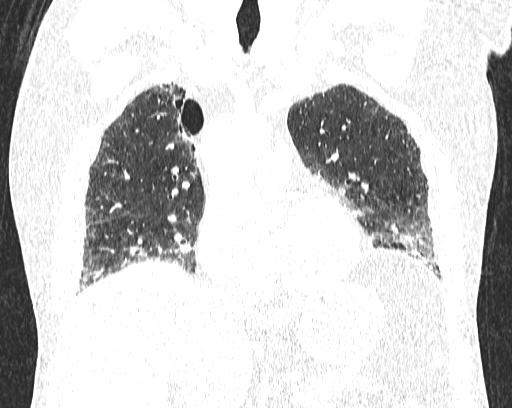 Non-specific interstitial pneumonia (NSIP) (Radiopaedia 68599-78228 Coronal lung window 37).jpg