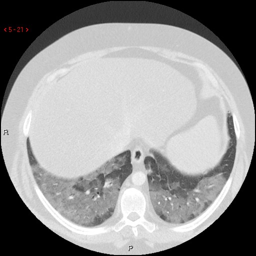 File:Non-specific interstitial pneumonitis (Radiopaedia 27044-27222 Axial lung window 12).jpg