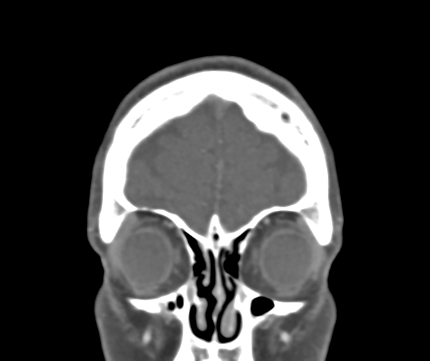 File:Normal CTA head (Radiopaedia 40801-43464 B 17).png