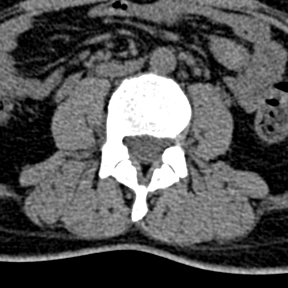 Normal CT lumbar spine (Radiopaedia 53981-60118 Axial non-contrast 58).jpg