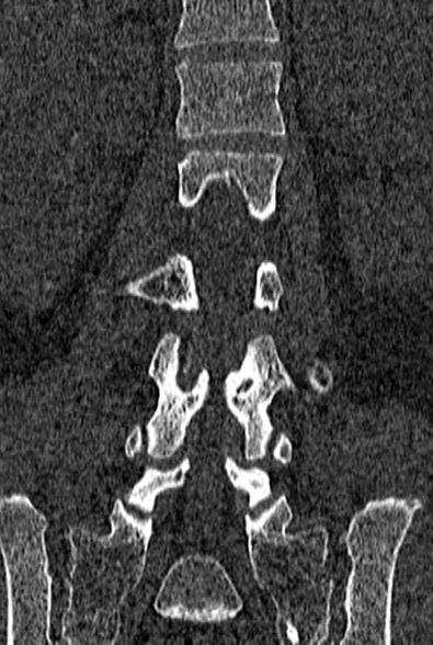 Normal CT lumbar spine (Radiopaedia 53981-60118 Coronal bone window 39).jpg