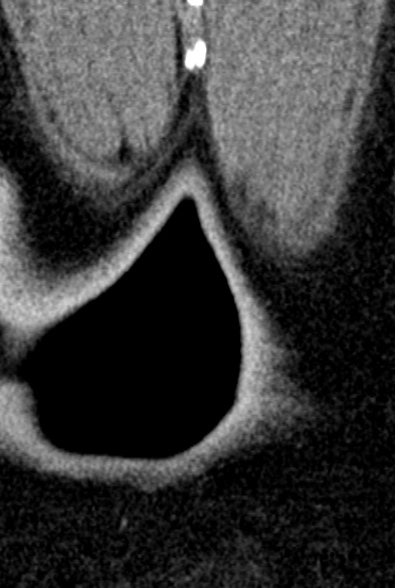 Normal CT lumbar spine (Radiopaedia 53981-60118 F 113).jpg