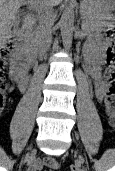 Normal CT lumbar spine (Radiopaedia 53981-60118 F 19).jpg