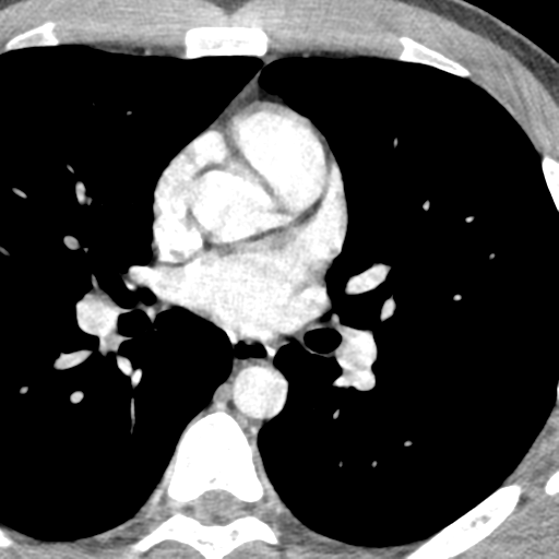 File:Normal CT pulmonary veins (pre RF ablation) (Radiopaedia 41748-44702 A 119).png