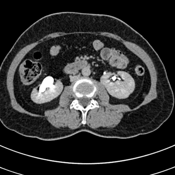 File:Normal CT split bolus study of the renal tract (Radiopaedia 48631-53634 Axial split bolus 114).jpg
