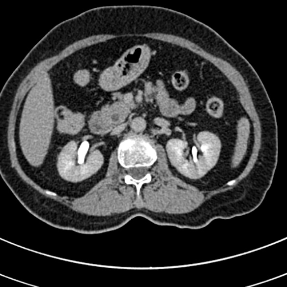 File:Normal CT split bolus study of the renal tract (Radiopaedia 48631-53634 Axial split bolus 66).jpg