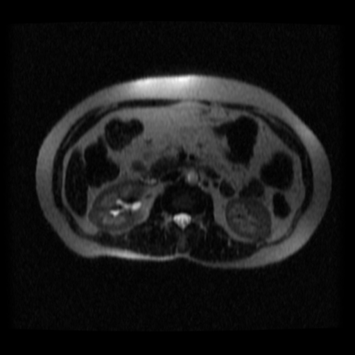 File:Normal MRCP (Radiopaedia 41966-44978 Axial T2 thins 7).png