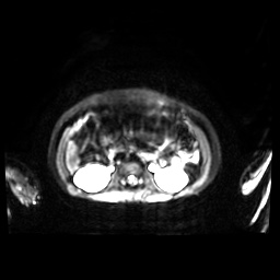 Normal MRI abdomen in pregnancy (Radiopaedia 88001-104541 Axial DWI 32).jpg