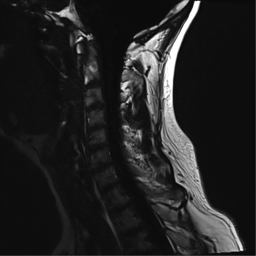 File:Normal MRI cervical spine (infection protocol) (Radiopaedia 53916-60039 F 10).png