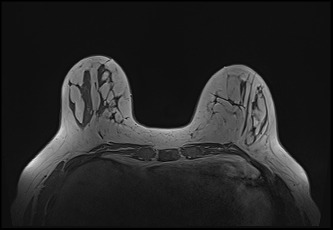 File:Normal breast MRI - dense breasts (Radiopaedia 80454-93850 Axial T1 68).jpg
