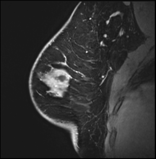 Normal breast MRI - dense breasts (Radiopaedia 80454-93850 I 54).jpg