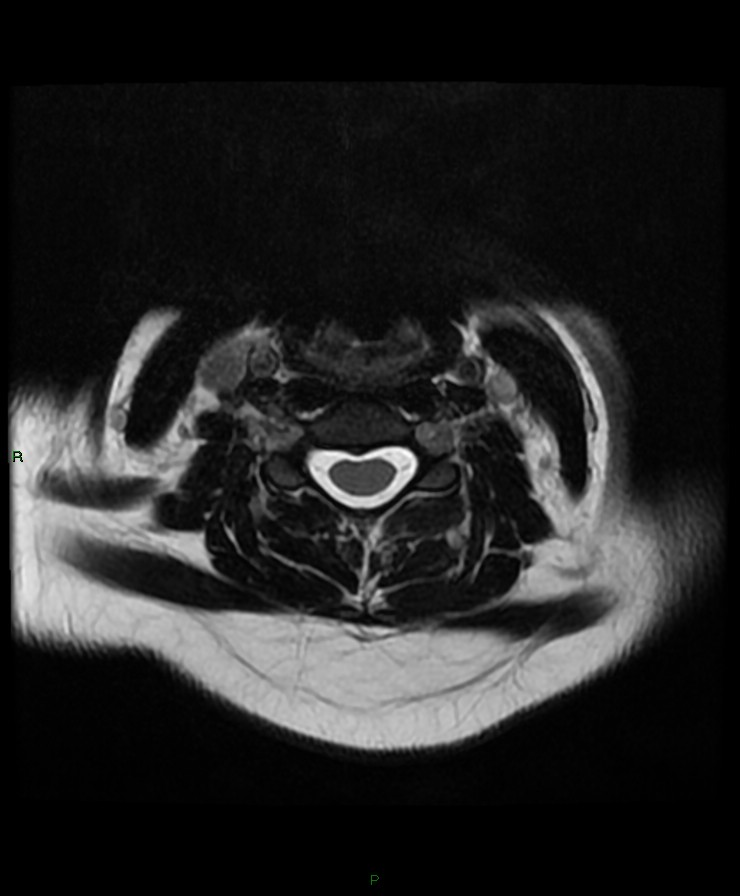Normal cervical spine MRI (Radiopaedia 80146-93454 Axial T2 47).jpg