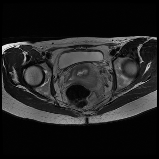 File:Normal female pelvis MRI (retroverted uterus) (Radiopaedia 61832-69933 Axial T2 20).jpg