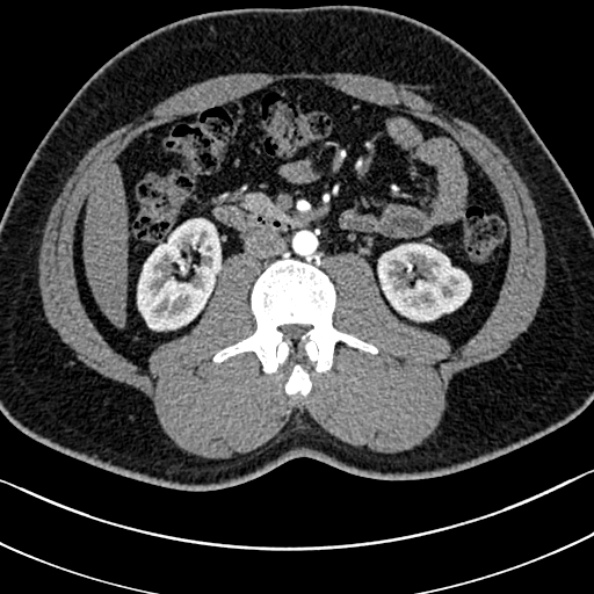 Normal kidneys on 4-phase CT study (Radiopaedia 25889-26038 B 56).jpg