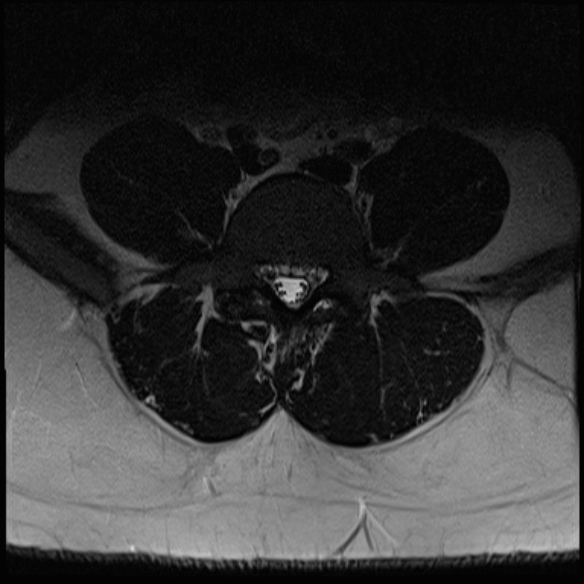 File:Normal lumbar spine MRI (Radiopaedia 47857-52609 Axial T2 21).jpg