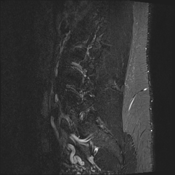 File:Normal lumbar spine MRI (Radiopaedia 47857-52609 Sagittal STIR 18).jpg