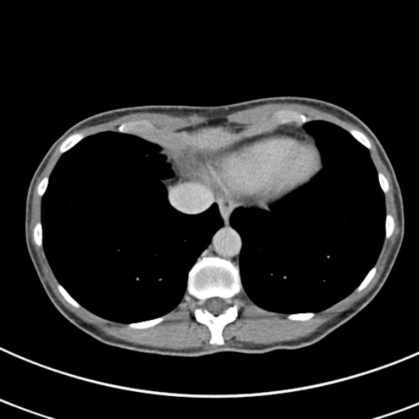 File:Normal multiphase CT liver (Radiopaedia 38026-39996 Axial C+ delayed 3).jpg