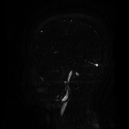 Normal noncontrast MR venography (Radiopaedia 87578-103957 A 128).jpg