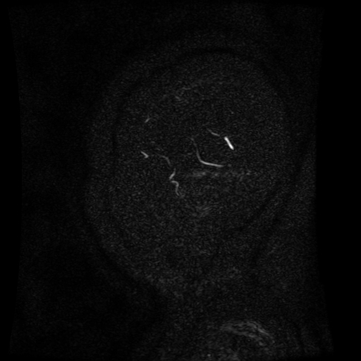 Normal noncontrast MR venography (Radiopaedia 87578-103957 A 168).jpg