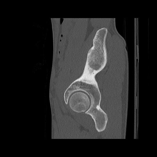 Normal pelvis (Radiopaedia 51473-57238 Sagittal bone window 109).jpg
