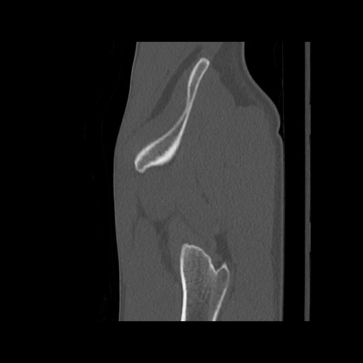 Normal pelvis (Radiopaedia 51473-57238 Sagittal bone window 129).jpg