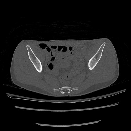 Normal pelvis CT (Radiopaedia 51471-57236 Axial bone window 50).jpg