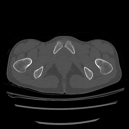 Normal pelvis CT (Radiopaedia 51471-57236 Axial bone window 87).jpg