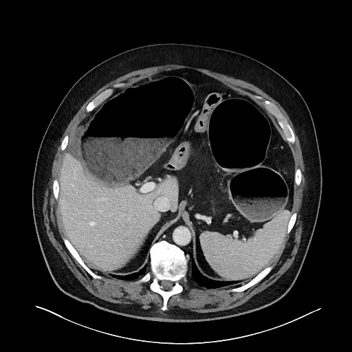File:Obstructing sigmoid adenocarcinoma (Radiopaedia 58465-65619 A 41).jpg