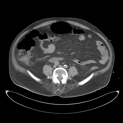 File:Obstructive pyelonephritis (Radiopaedia 46411-50844 Axial non-contrast 48).png
