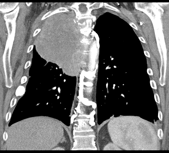 File:Obstructive superior vena cava tumor thrombus (Radiopaedia 28046-28306 B 34).jpg