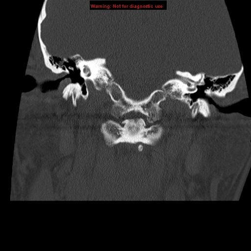 File:Occipital condyle fracture (Radiopaedia 18366-18208 Coronal bone window 5).jpg