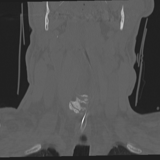 File:Occipital condyle fracture (Radiopaedia 33467-34517 Coronal bone window 16).png