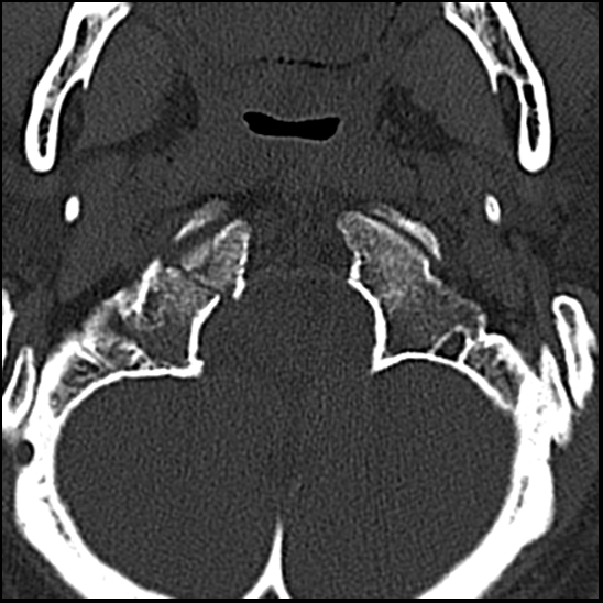 Occipital condyle fracture (type 1) (Radiopaedia 87670-104084 Axial bone window 11).jpg