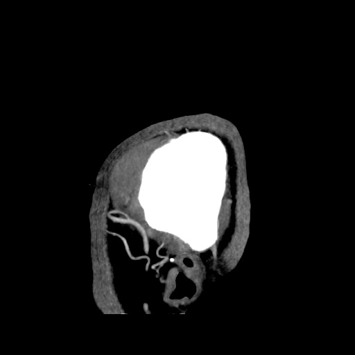 Occipital extradural hematoma simulating venous sinus thrombosis (Radiopaedia 46514-50964 D 4).jpg