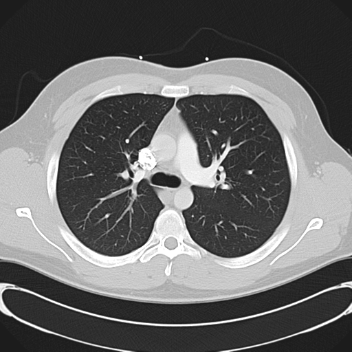 'Bovine' aortic arch (Radiopaedia 33554-34637 Axial lung window 23).png