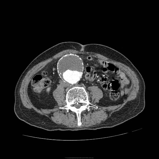 Abdominal aortic aneurysm (Radiopaedia 13341-13340 Axial C+ arterial phase 126).jpg