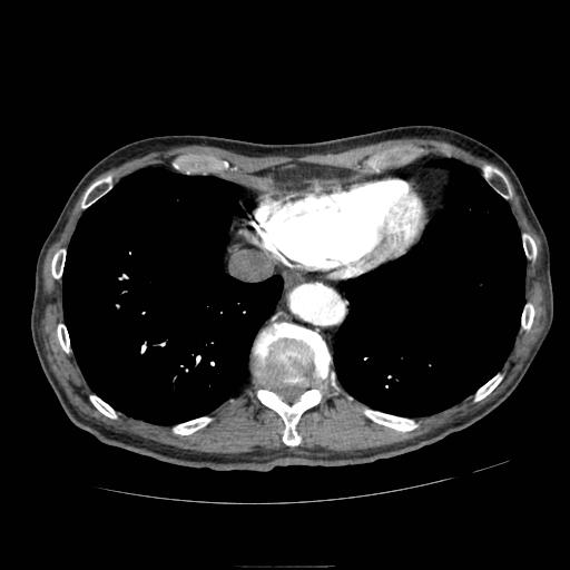 Abdominal aortic aneurysm (Radiopaedia 13341-13340 Axial C+ arterial phase 3).jpg