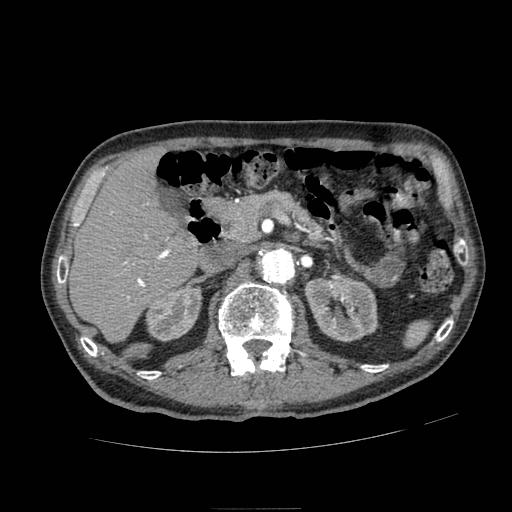 Abdominal aortic aneurysm (Radiopaedia 13341-13340 Axial C+ arterial phase 63).jpg