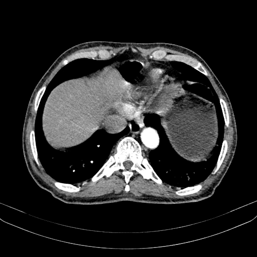 Abdominal aortic aneurysm (Radiopaedia 83581-98689 Axial C+ arterial phase 15).jpg