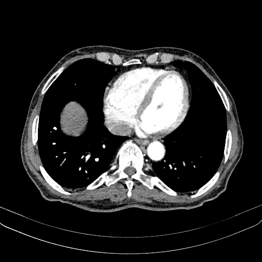 Abdominal aortic aneurysm (Radiopaedia 83581-98689 Axial C+ arterial phase 9).jpg