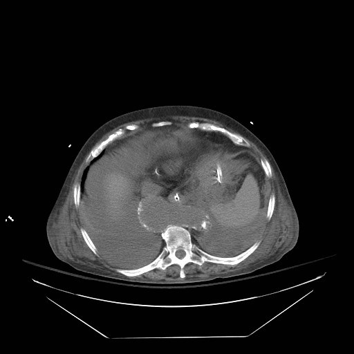 Abdominal aortic aneurysm - impending rupture (Radiopaedia 19233-19247 Axial non-contrast 31).jpg