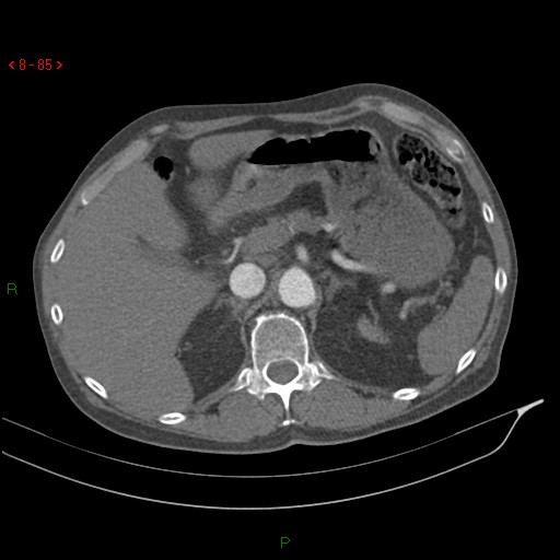 Abdominal aortic aneurysm rupture with aortocaval fistula (Radiopaedia 14897-14841 Axial C+ arterial phase 85).jpg