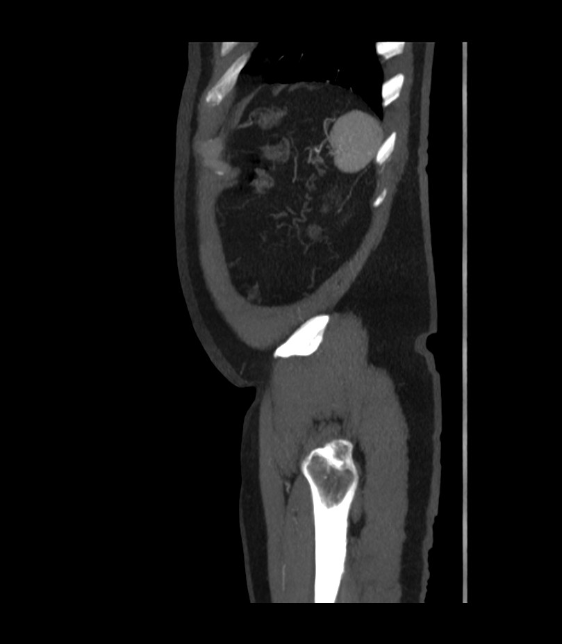 Abdominal aortic aneurysm with thrombus fissuration (Radiopaedia 46218-50618 Sagittal C+ arterial phase 53).jpg