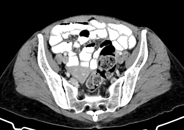 Abdominal wall and retroperitoneal tuberculosis (Radiopaedia 88137-104729 Axial C+ portal venous phase 150).jpg