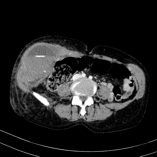 File:Abdominal wall hematoma with active bleeding (Radiopaedia 83915-99117 Axial C+ portal venous phase 68).jpg