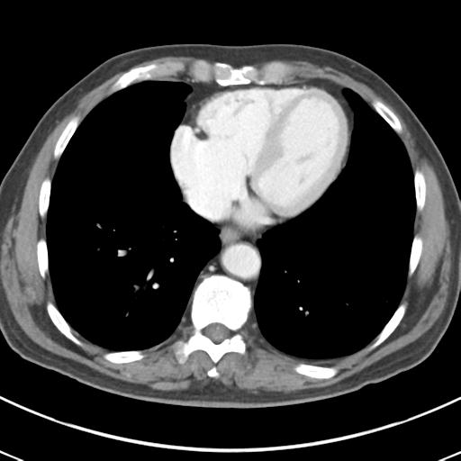 Abdominal wall metastasis from colorectal carcinoma (Radiopaedia 31016-31717 Axial C+ portal venous phase 7).jpg