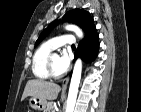 File:Aberrant right subclavian artery (Radiopaedia 67135-76475 Sagittal C+ arterial phase 24).jpg